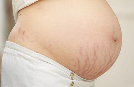 妊娠線